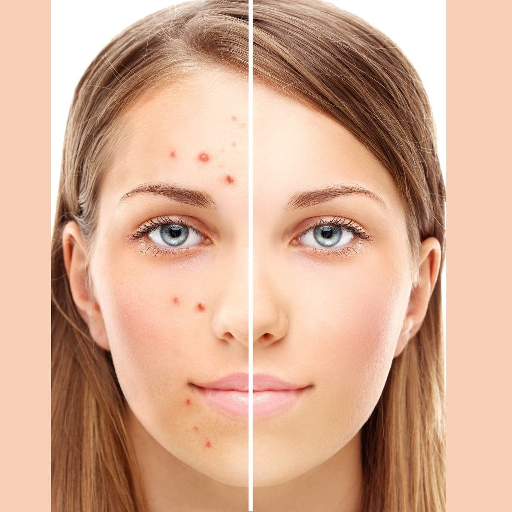 Manifest CLEAR SKIN | 30 Min Potent Hypnosis | Potent Subliminal Audio
