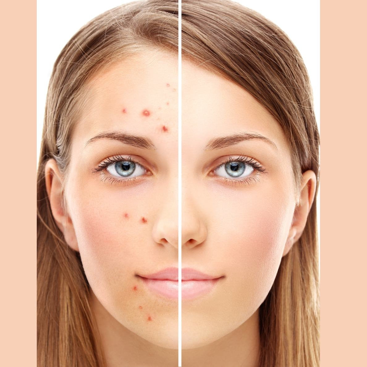 Manifest CLEAR SKIN | 30 Min Potent Hypnosis | Potent Subliminal Audio